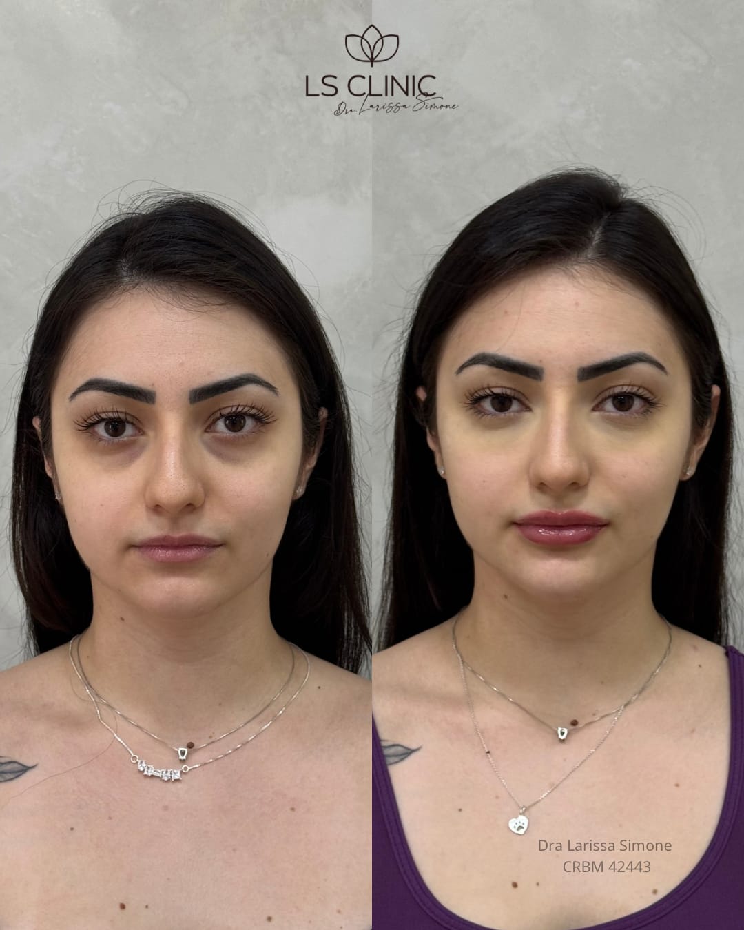 Resultado harmonizacao facial