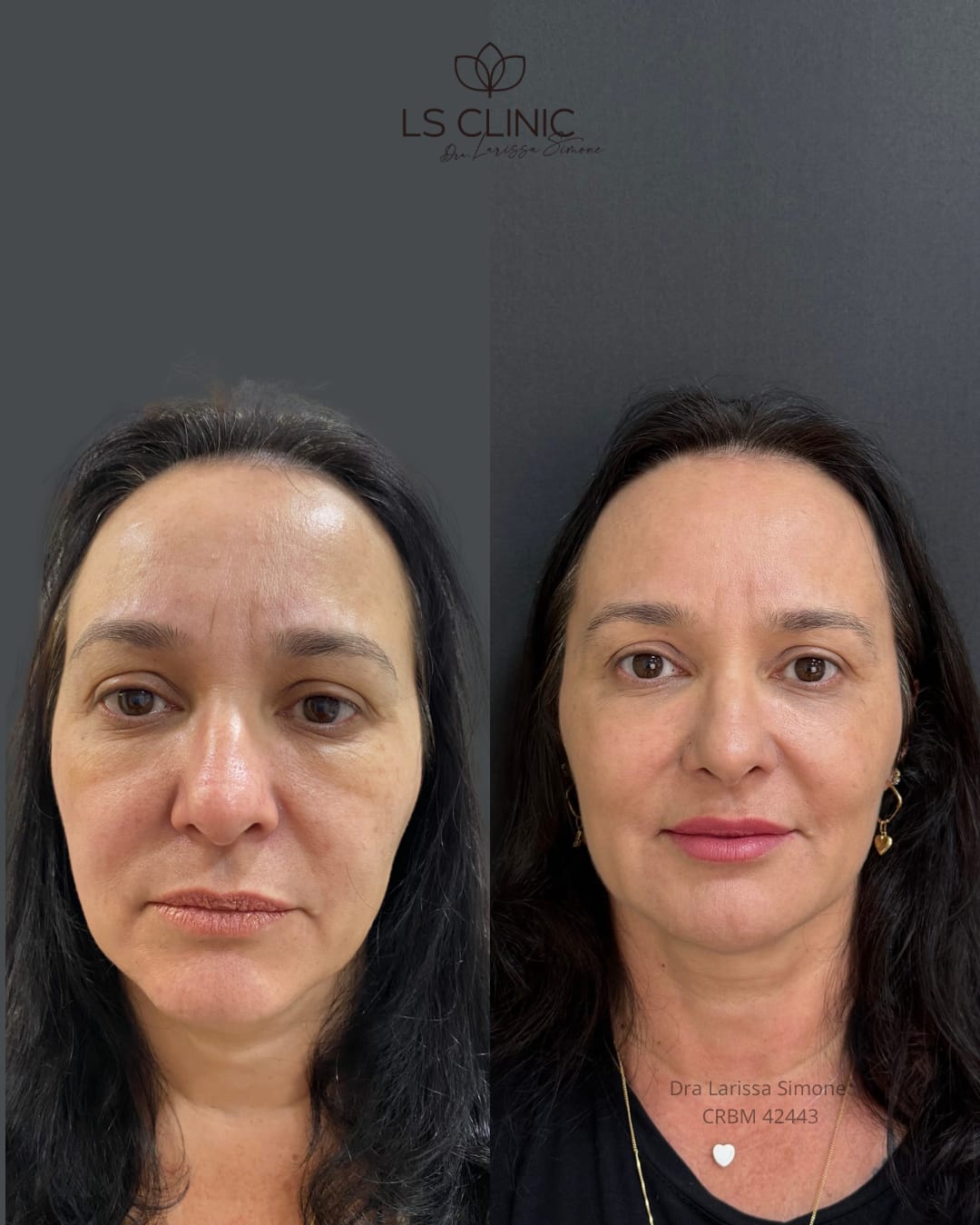 Resultado rejuvenescimento completo