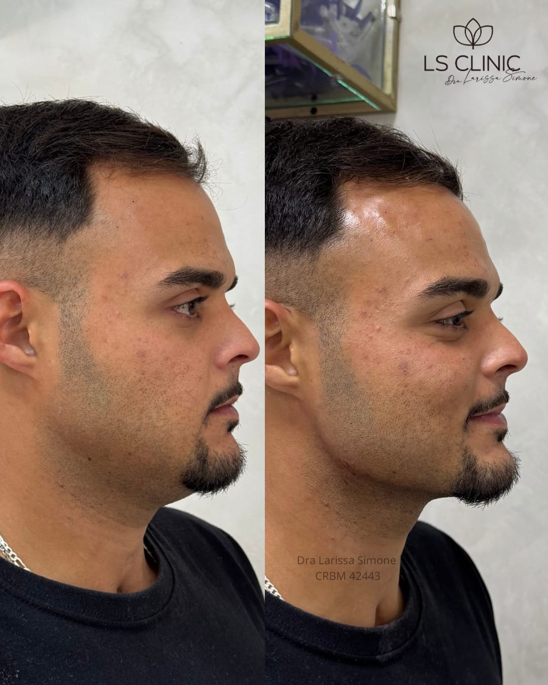 Resultado contorno mandibular