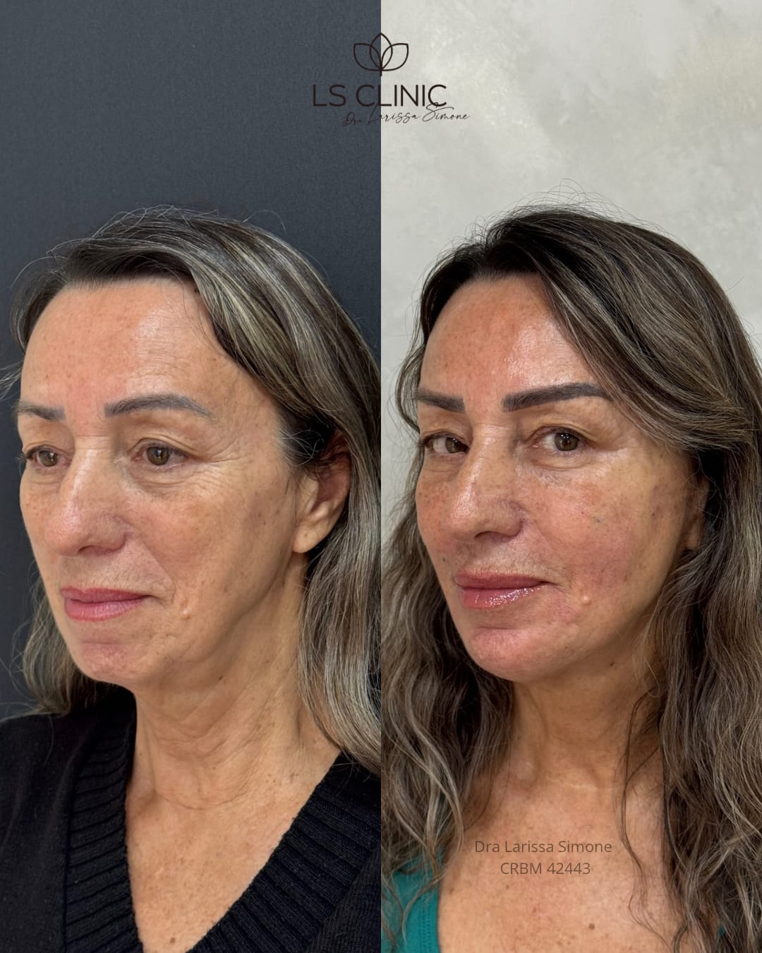Resultado rejuvenescimento avancado