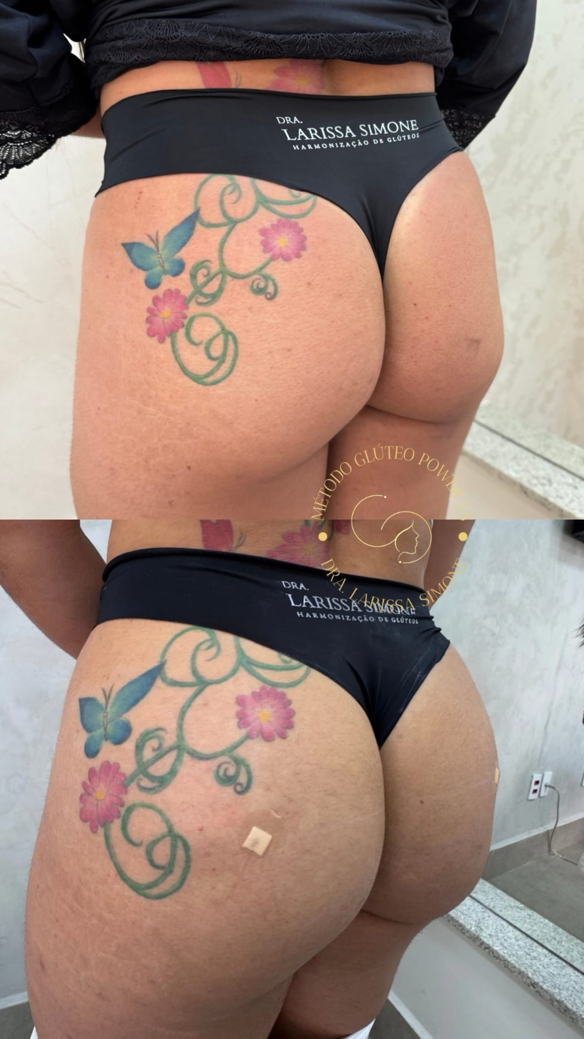 Resultado harmonizacao gluteos