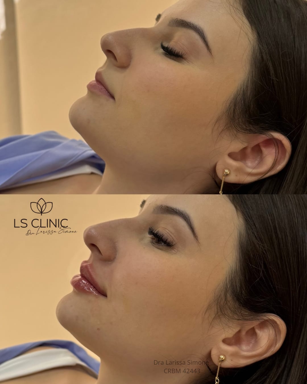 Resultado perfil labios