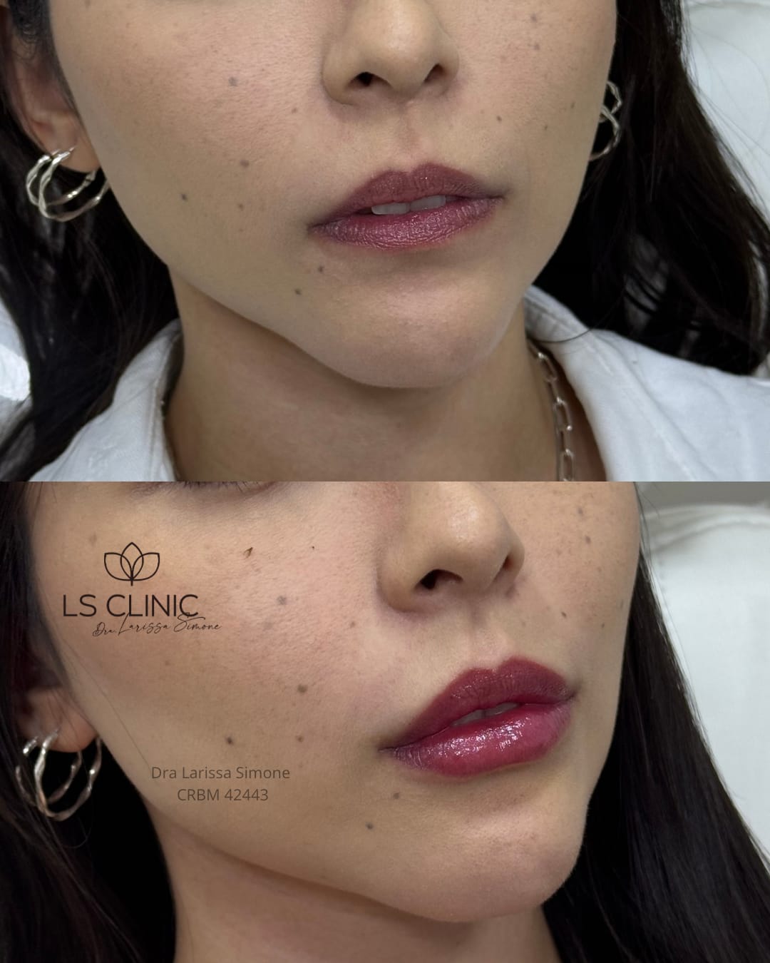 Resultado preenchimento labial