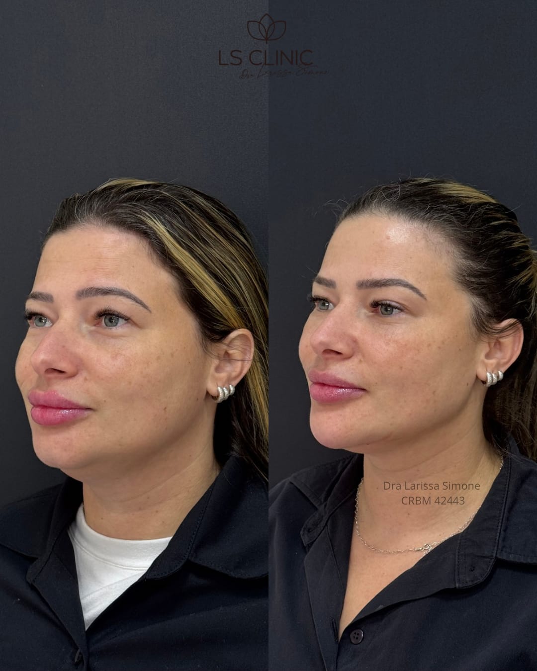 Resultado contorno facial