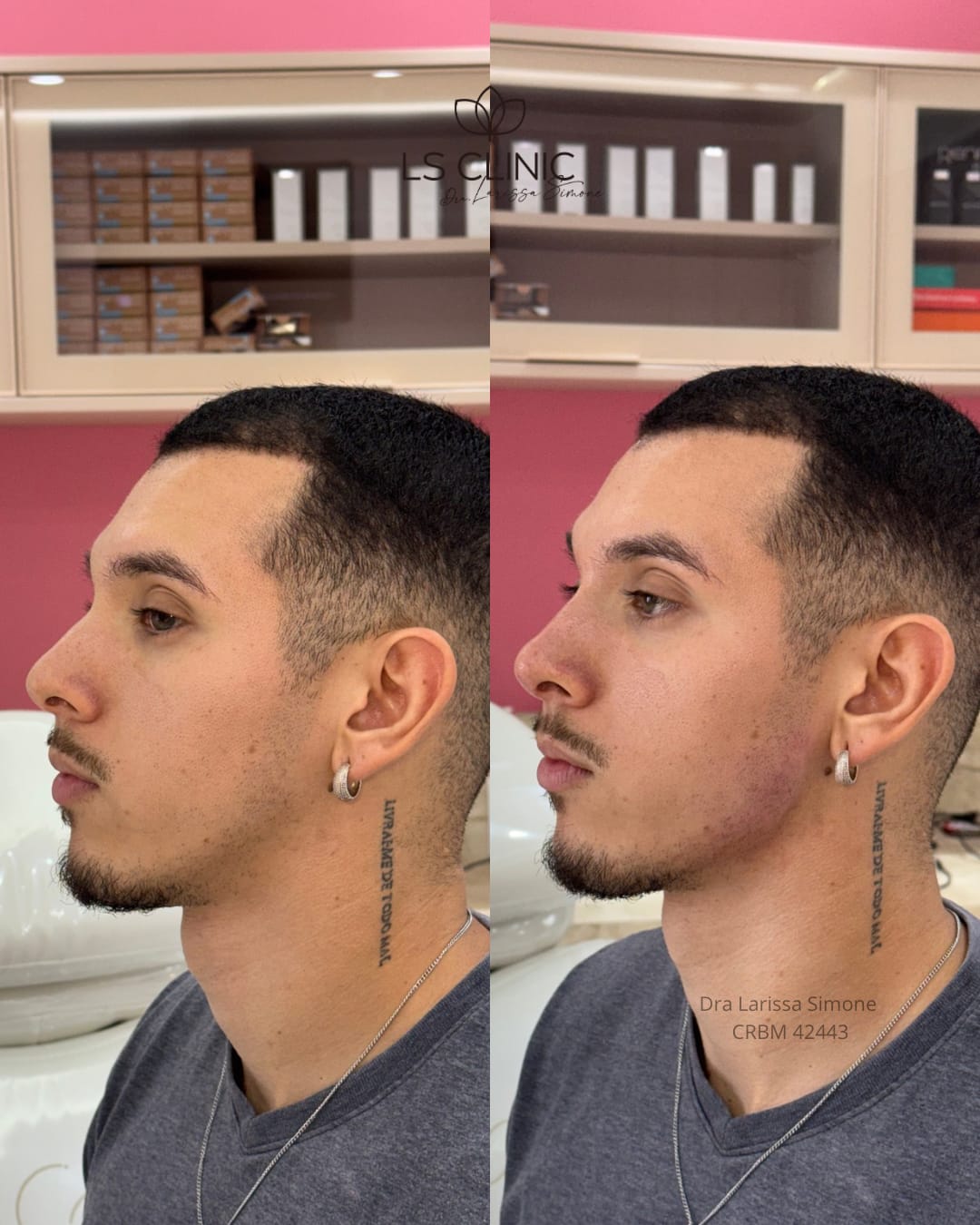 Resultado harmonizacao masculina