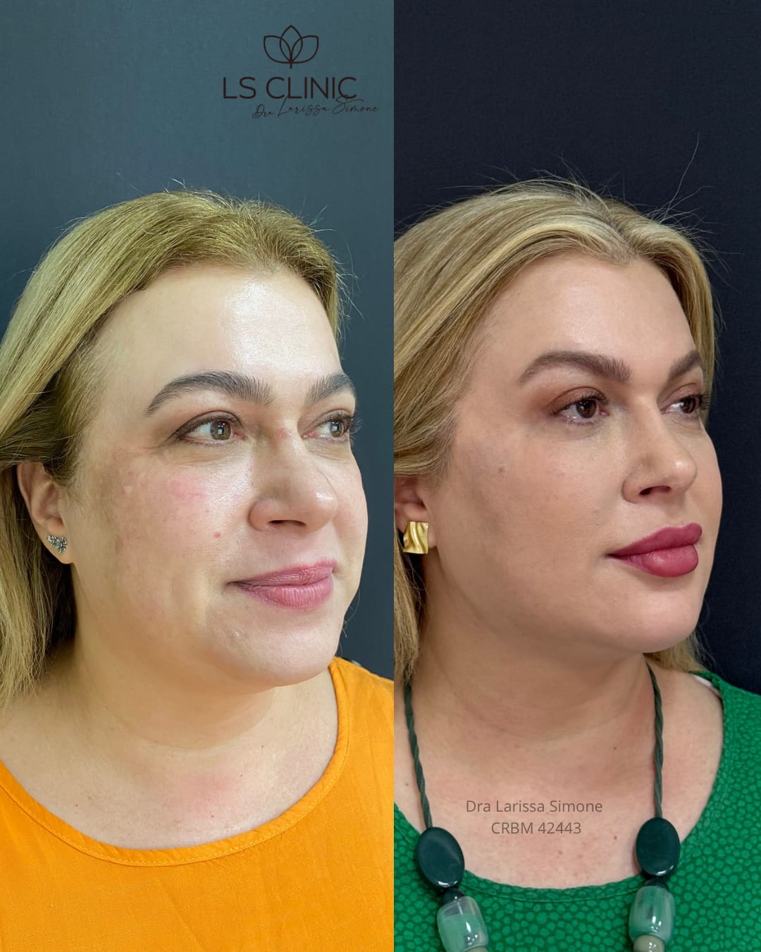 Resultado rejuvenescimento facial