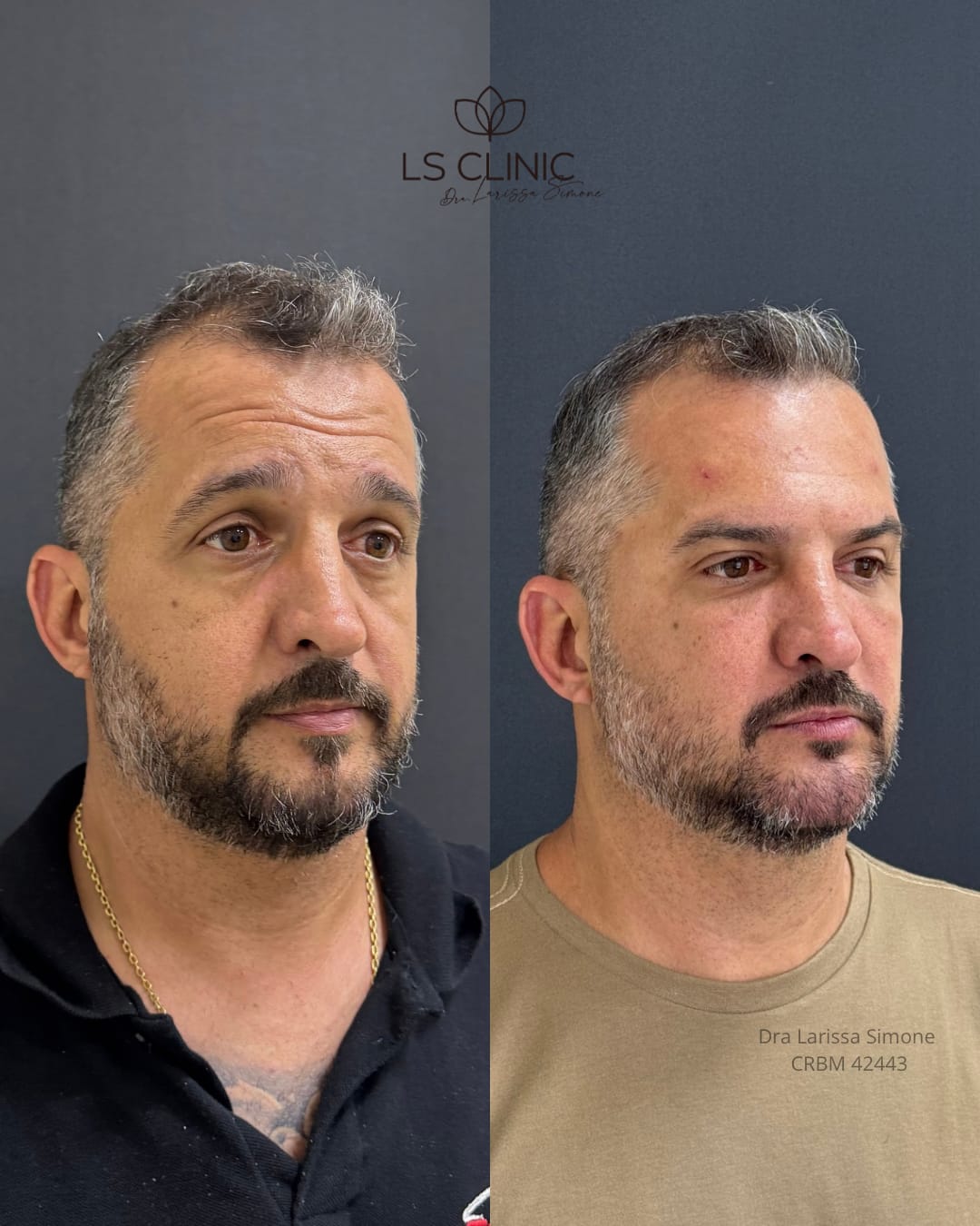 Resultado rejuvenescimento masculino